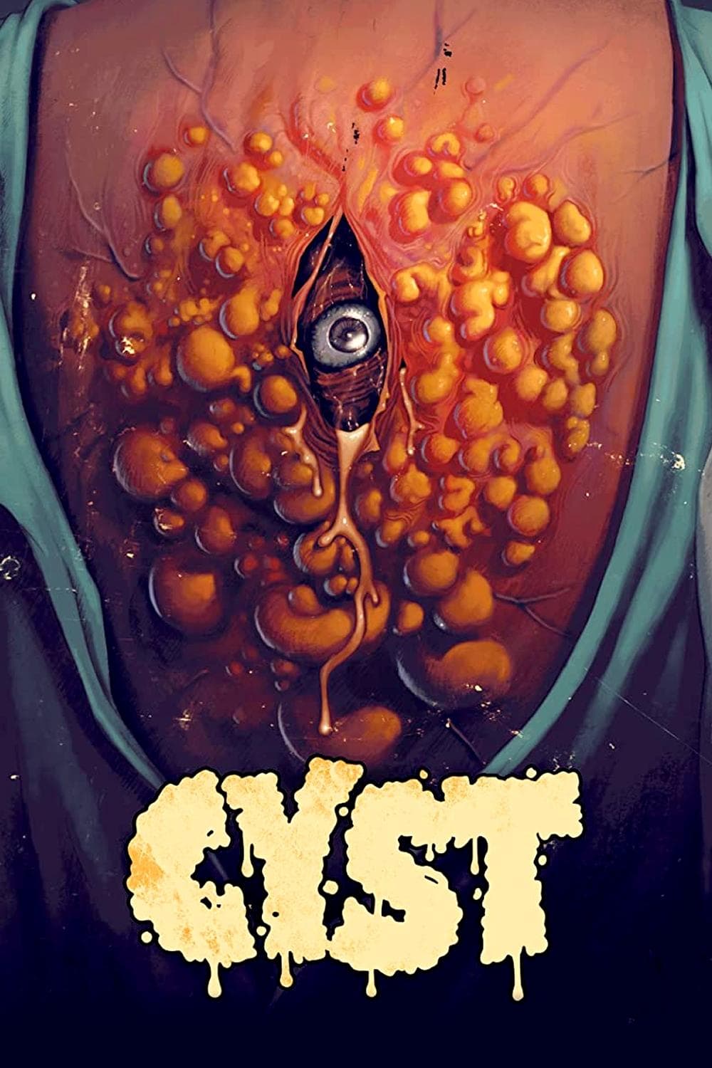 Cyst photo